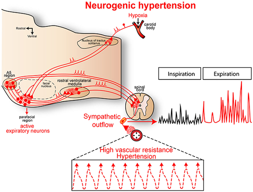 Diagram of neurogenic hypertension: brainstem control of sympathetic outflow to blood vessels, causing high vascular resistance and hypertensive spikes in BP trace