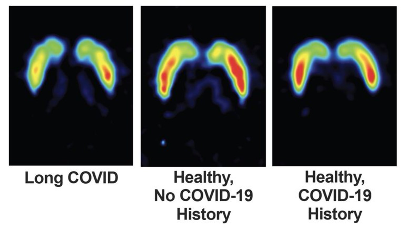 Three lung heatmaps in a row: left shows Long COVID with red hotspots, center shows Healthy with no COVID-19 history, right shows Healthy with COVID-19 history.