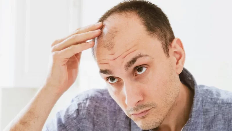 مقابله با طاسی