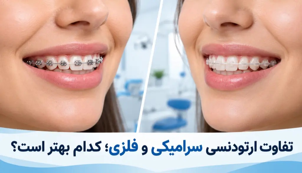 تفاوت ارتودنسی سرامیکی و فلزی؛ کدام بهتر است؟